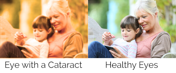 Cataract Symptoms