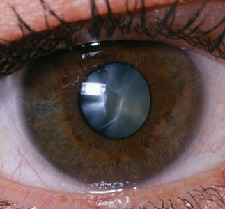 Cataract in Eye